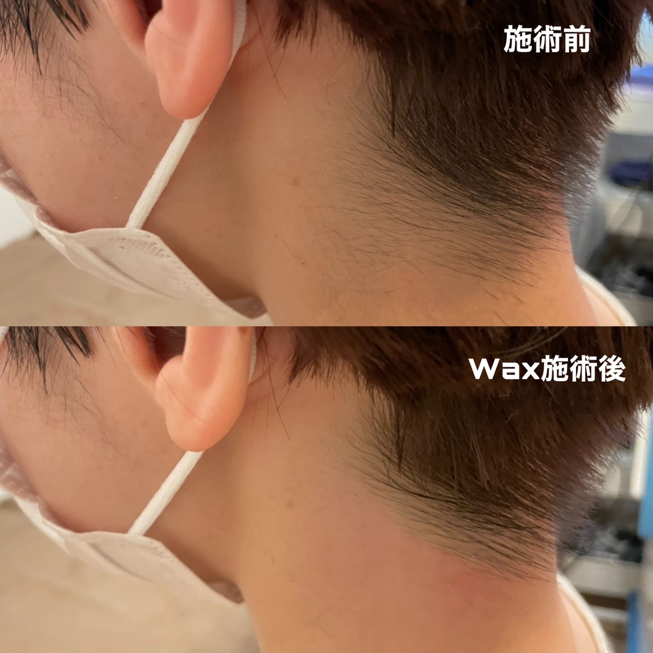 うなじ脱毛の施術画像