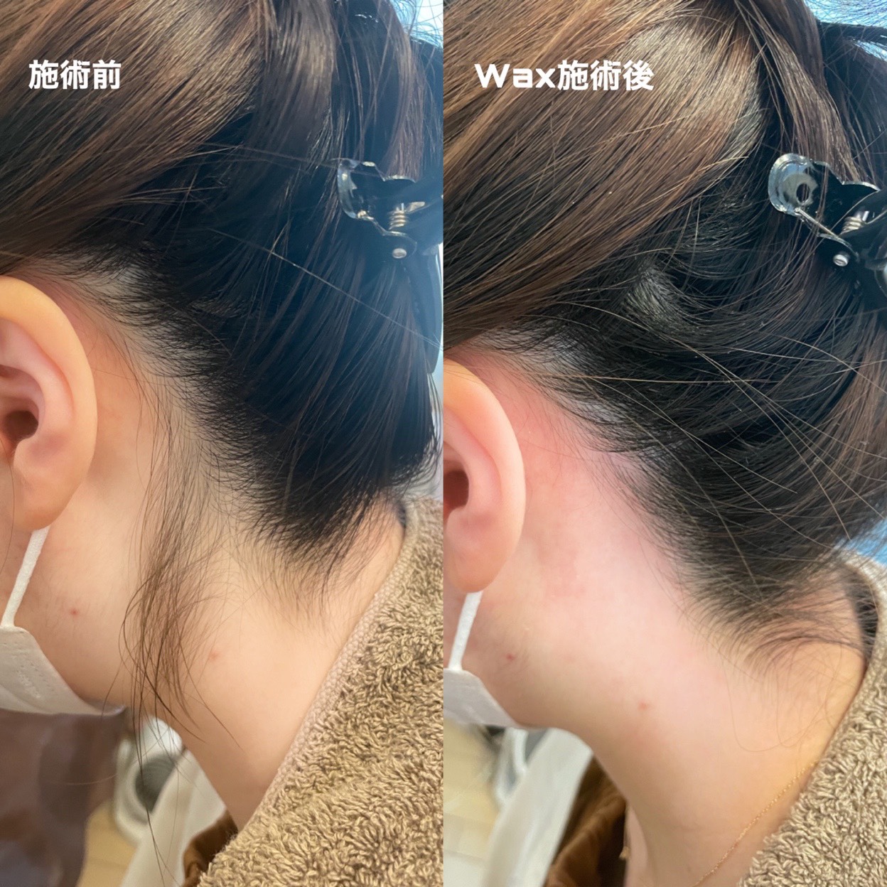 うなじ脱毛の施術画像