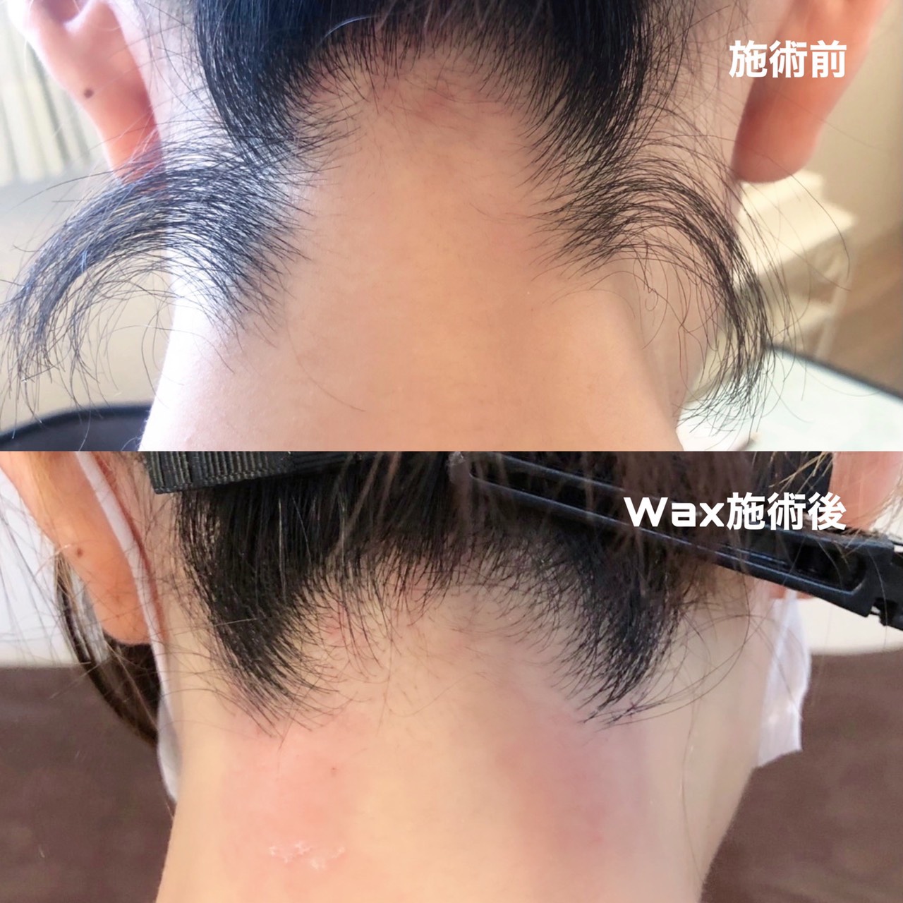 襟足脱毛の施術画像