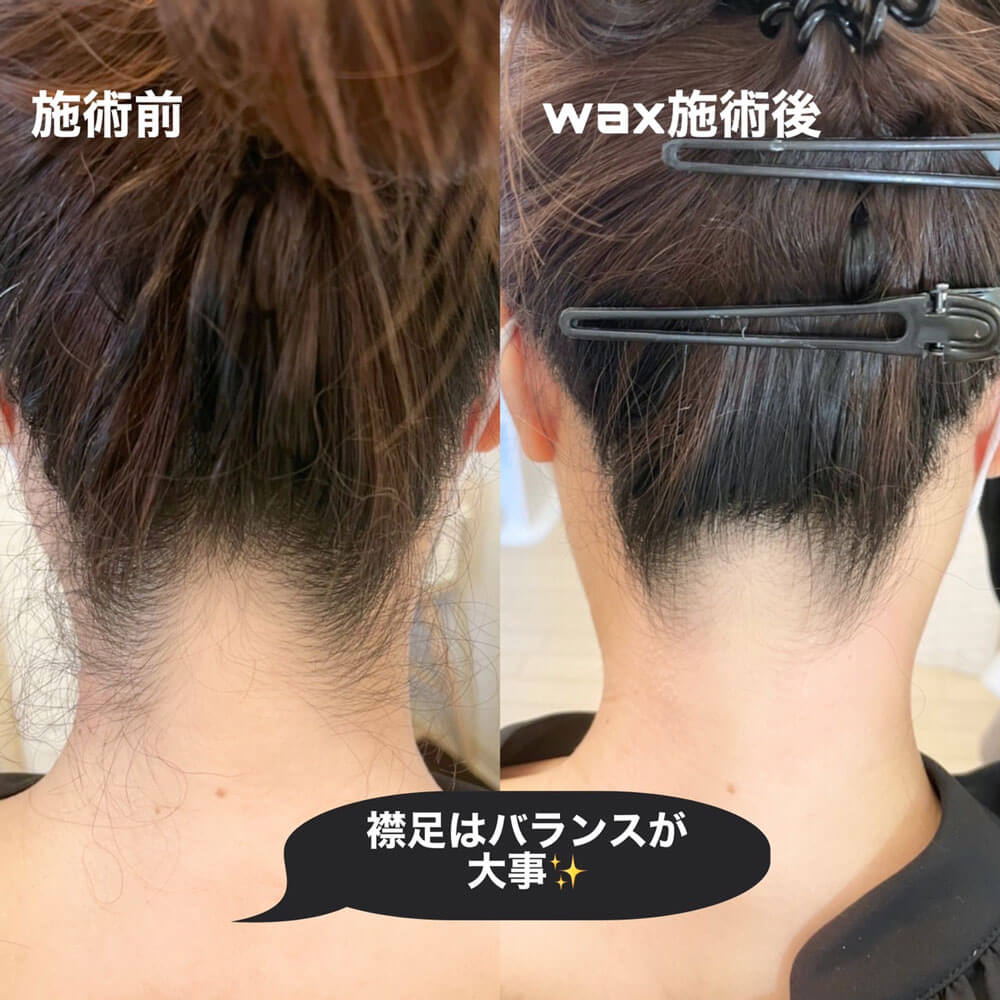 うなじ脱毛のビフォーアフターの写真