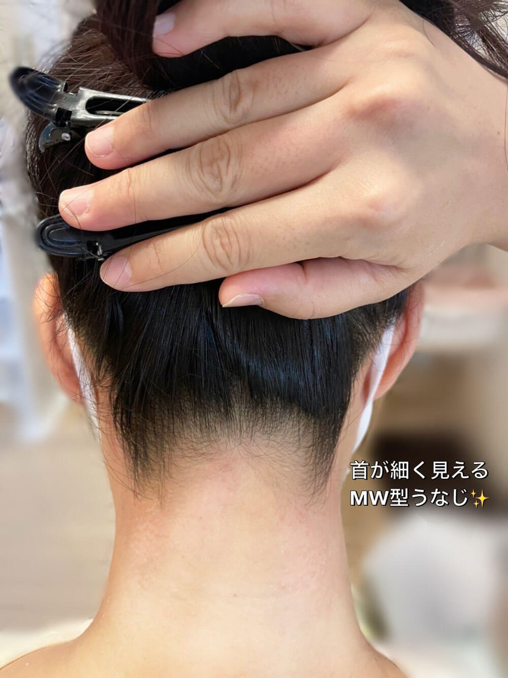 うなじ脱毛施術後の写真