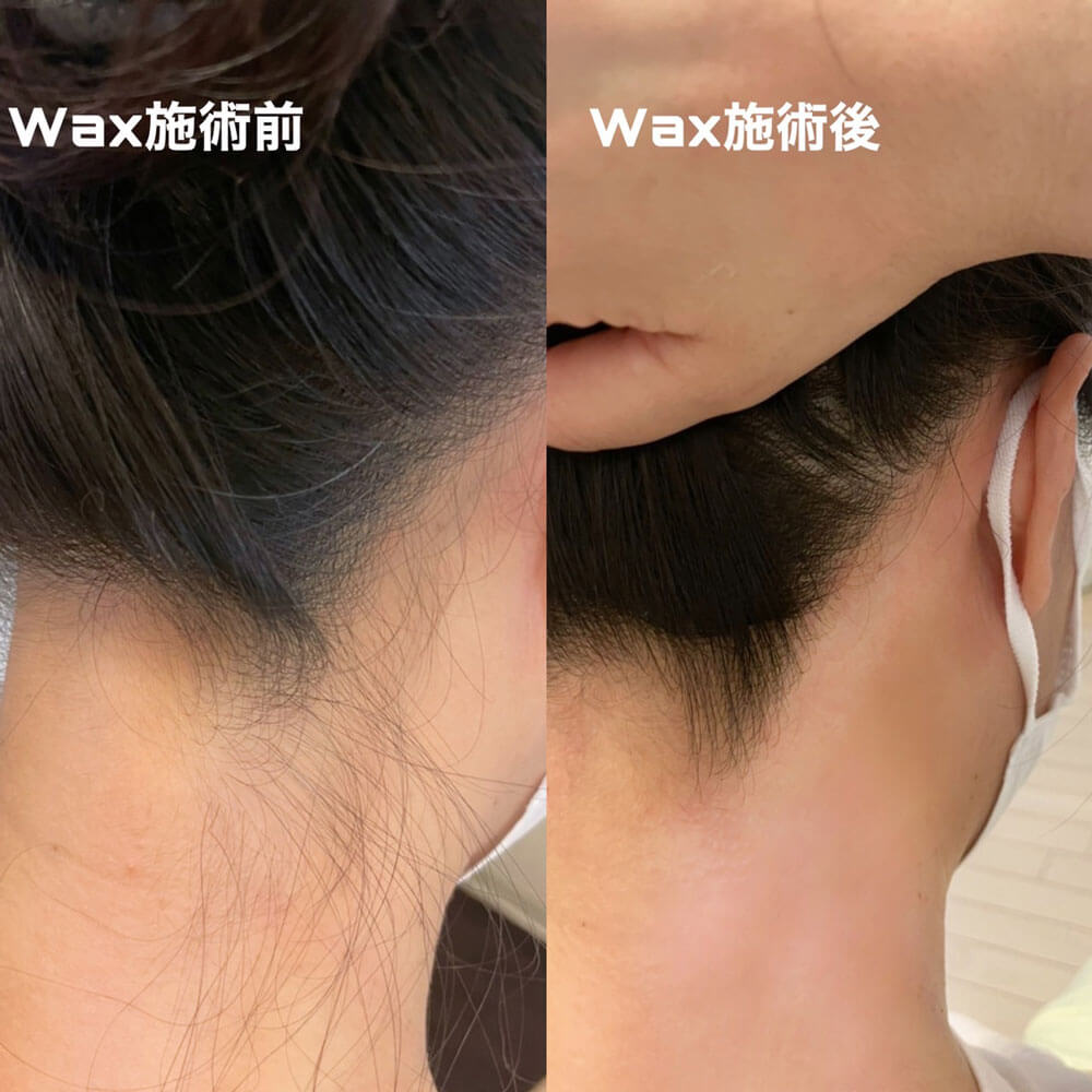 うなじ脱毛施術後の写真