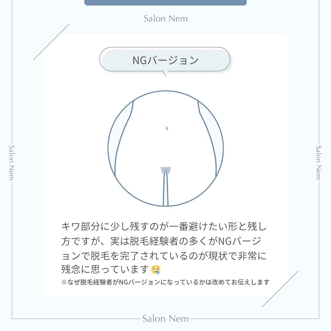 VIO脱毛NGバージョンのイラスト