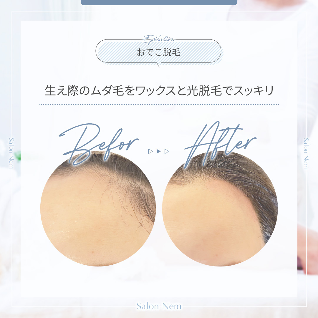 おでこ脱毛施術前と施術後の写真