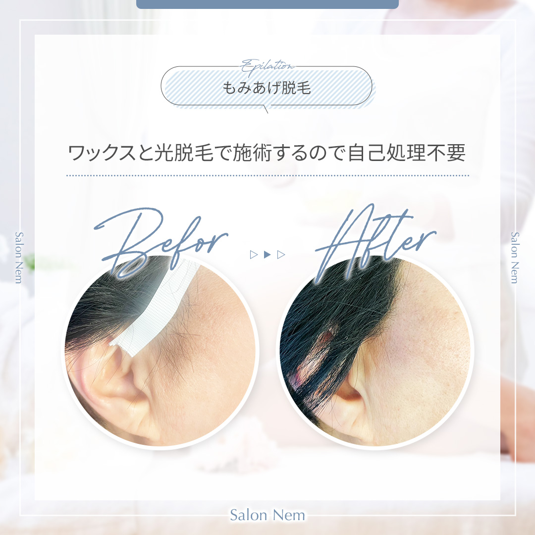もみあげ脱毛施術前と施術後の写真
