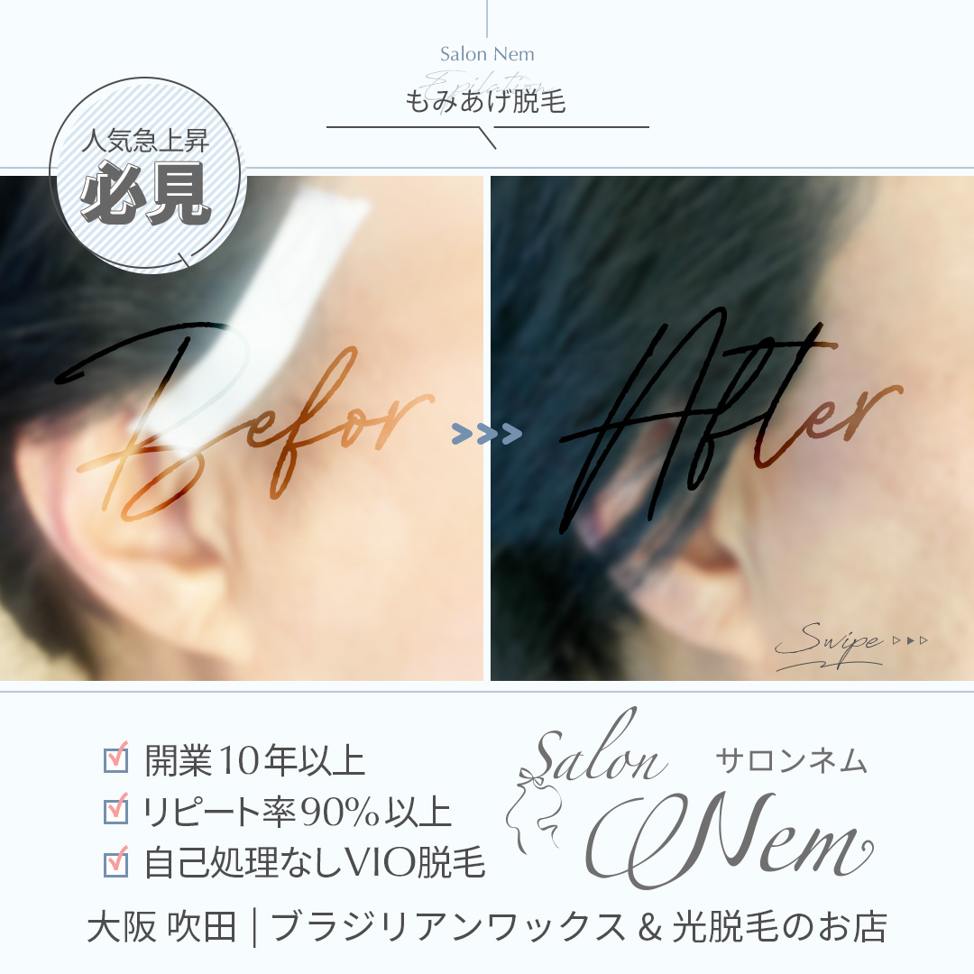 もみあげ脱毛